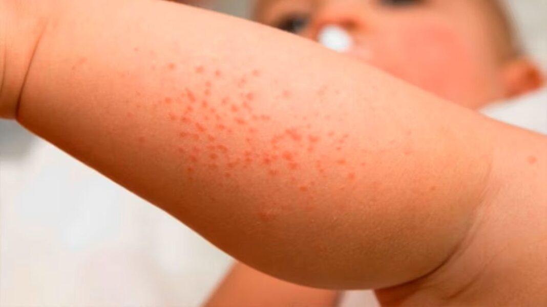 Persona aplicando crema en brazo con signos de dermatitis atópica