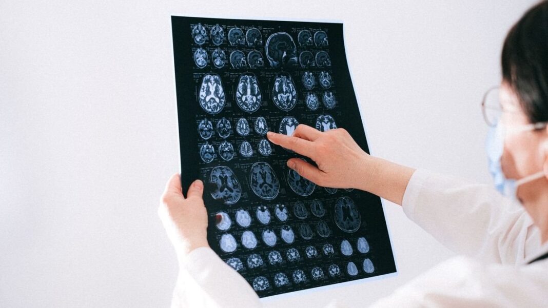 Ilustración de un cerebro humano con señales de alerta de ACV